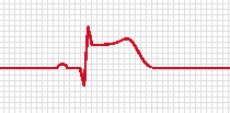 Picture an EKG showing an elevated T-Wave representing the STEMI Categorization section.